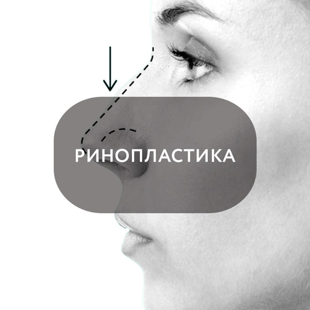 Ринопластика